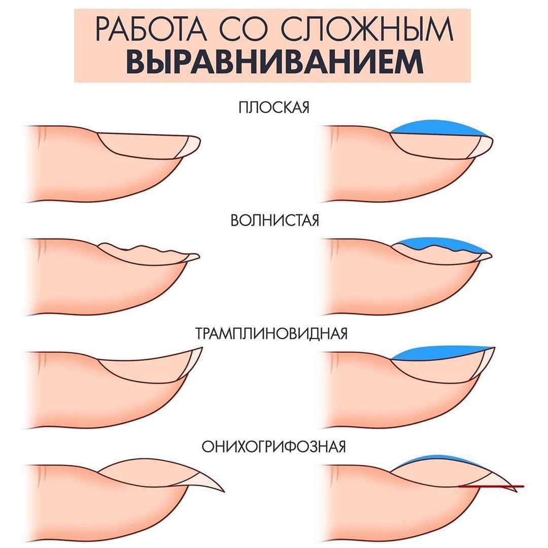 выравнивание ногтевой пластины
